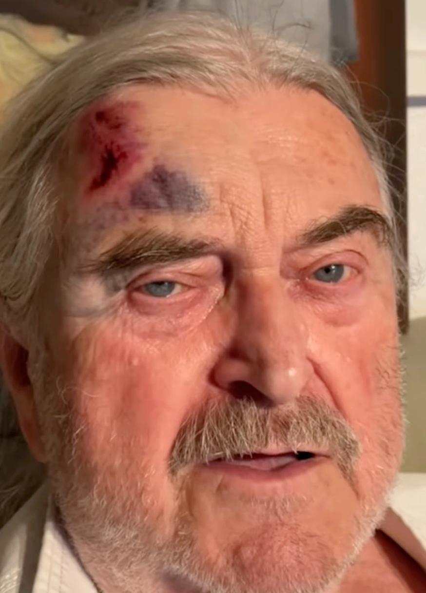 Zkrvavený František Ringo Čech přiznal: Pravdu o monoklu nečekal nikdo