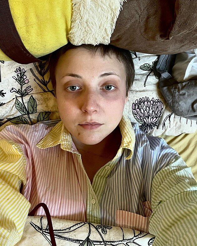 Anička Slováčková po chemoterapii.